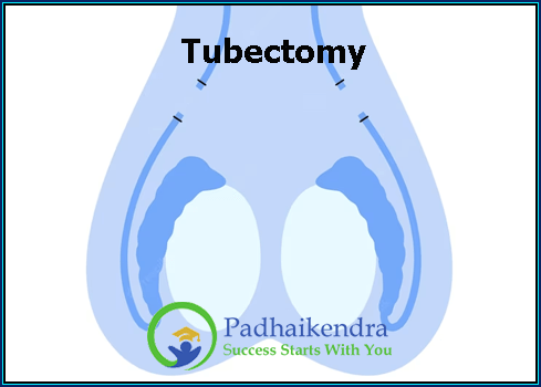 Tubectomy