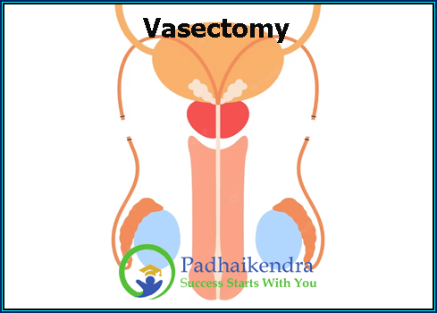 Vasectomy
