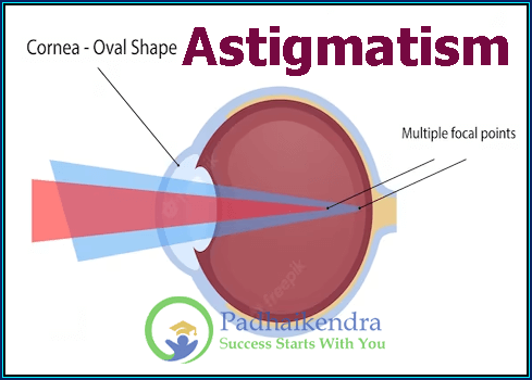 Astigmatism